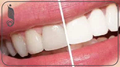 6 فروقات جوهرية بين الزيركون والإيماكس