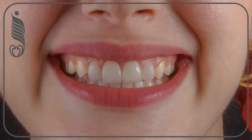 كيف بنخلّص من الابتسامة اللثوية بليزر بسيط؟